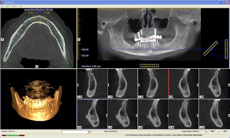 Cone beam computed tomography: basics and applications in dentistry.